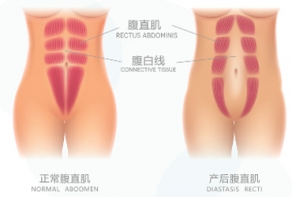 產(chǎn)后腹直肌修復(fù)